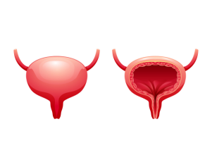 Chronic cystitis